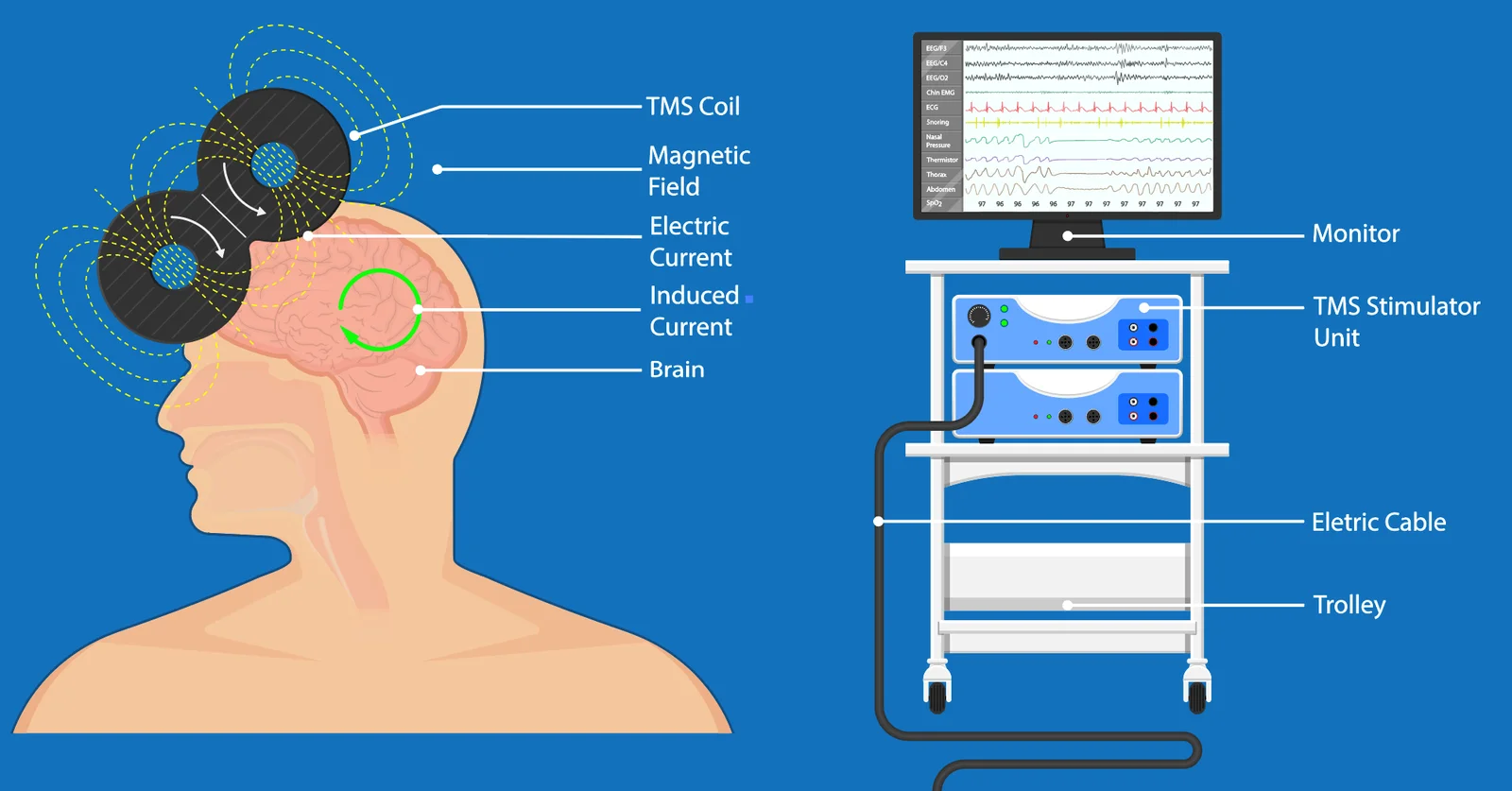 Implementing TMS as a Potential Solution for Treatment!
